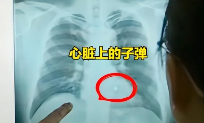“全球首例！”1995年，湖南，符桂林胸部中枪后，医生却没有在体内找到子弹！医生