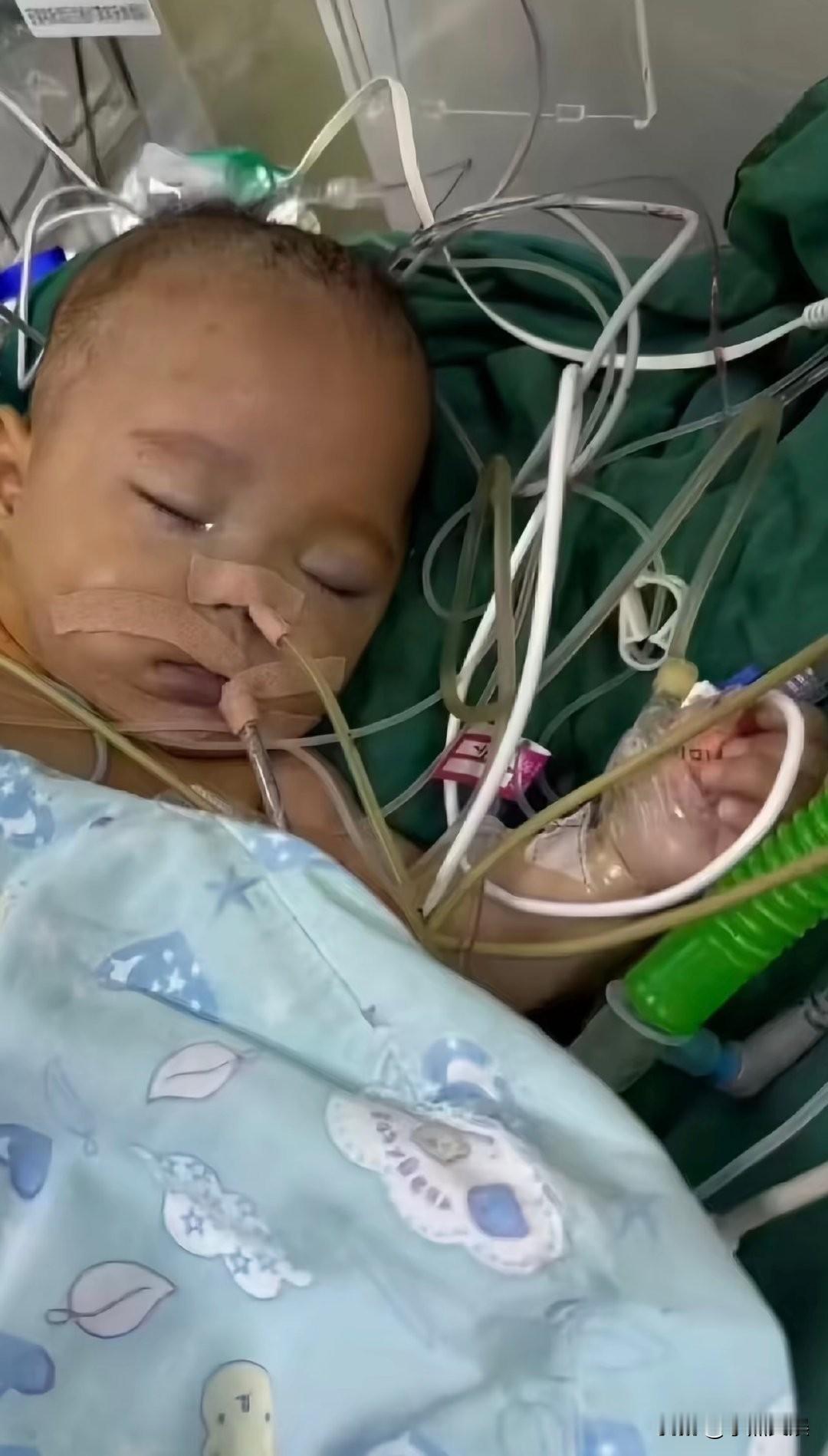 医生告知家属2小时的微创手术。
居然做了10个小时，而且还给5个月大的孩子做了全