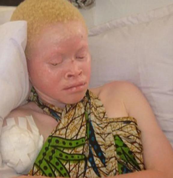 在非洲，一颗健康的肾脏只值一两千美元，但一具白化病患者的尸体却能卖到七万五。健健