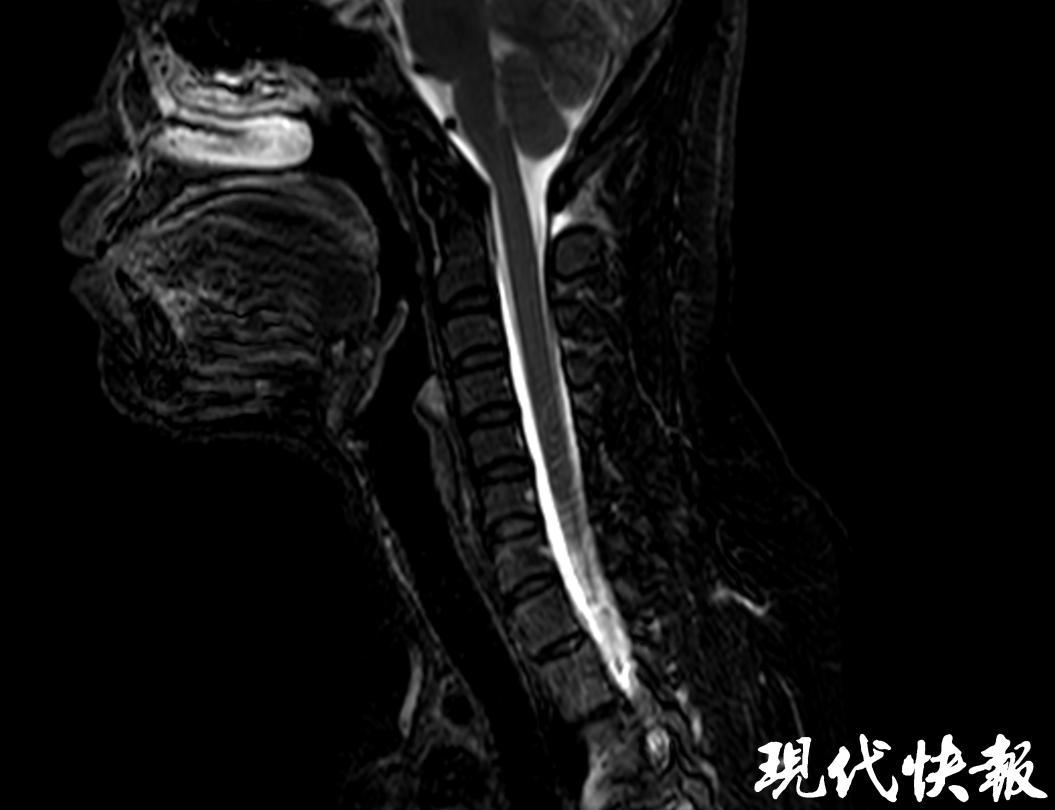 每年十多例，几乎全在健身房！南京27岁女子硬拉后站直瞬间头痛欲裂，躺下即缓解——