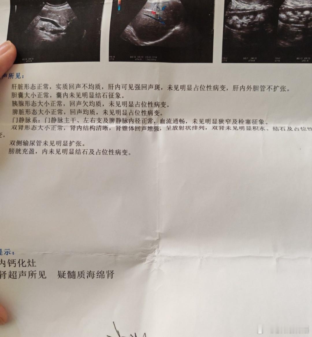 髓质海绵肾是一种先天性肾脏发育异常疾病。 一、病因 病因尚不明确，多认为是先天性
