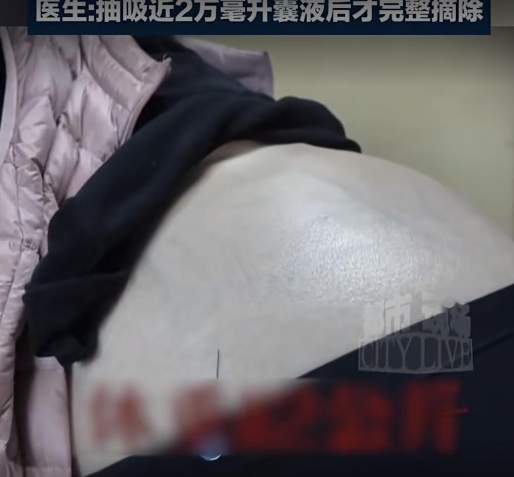 西安一名40岁女子腹腔长出52公斤罕见巨瘤，瘤重将近体重一半，脏器受压不能平躺，