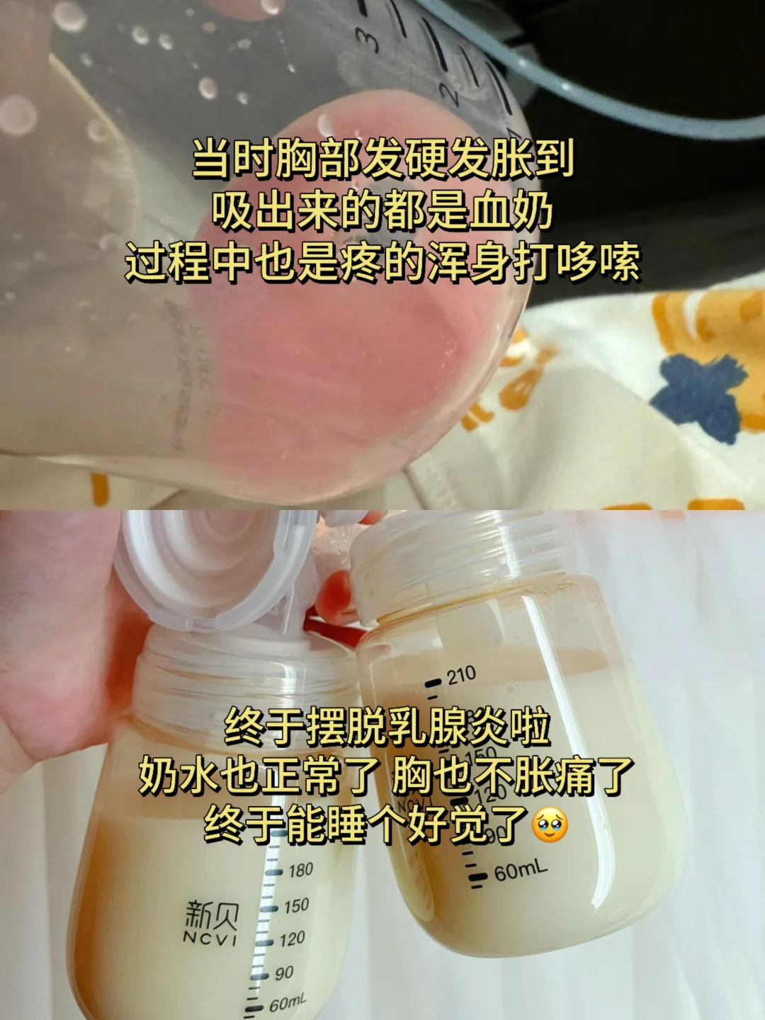 乳腺炎逐渐恢复的6个小技巧！码住