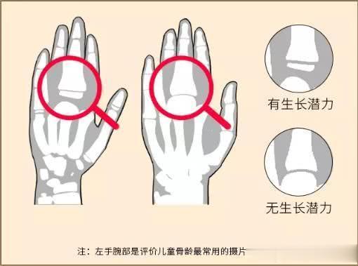 【家长提问】骨龄偏大2岁多！还能控制住吗？
 
这个男孩13岁9个月，身高165