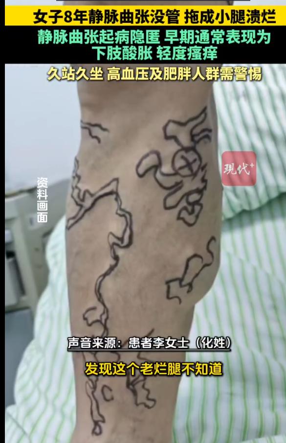 江苏南京，女子机关医院的病床上，终于弄清了折磨自己一个月的腿疼“元凶”。早在8年
