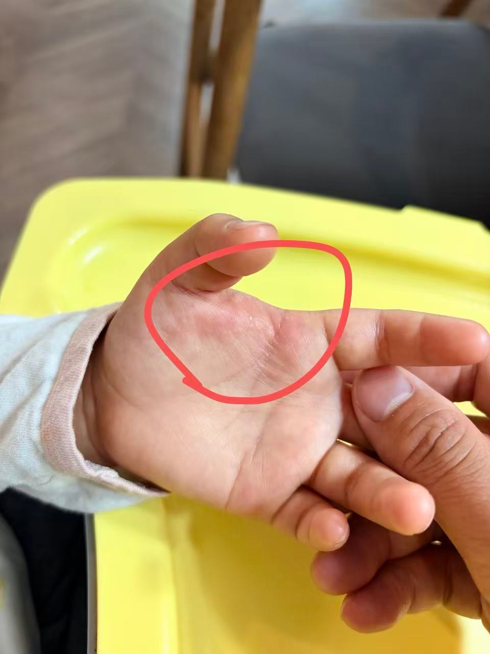 雾都奶爸 昨天早上起床娃手指缝出现一些小点说很痛（应该是很痒），擦了点药膏，今天