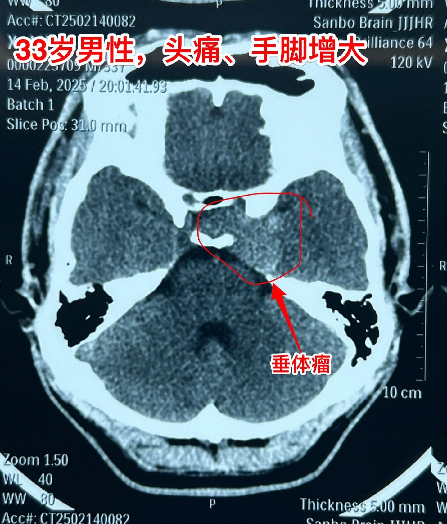 走来街上就能确诊的疾病：垂体生长激素腺瘤。有的疾病经过医生多年排查都不...