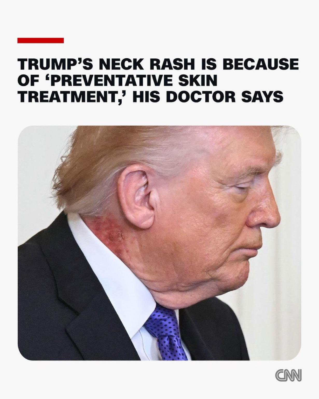 据美国有线电视新闻网（CNN）报道，唐纳德·特朗普总统的私人医生表示，特朗普颈部