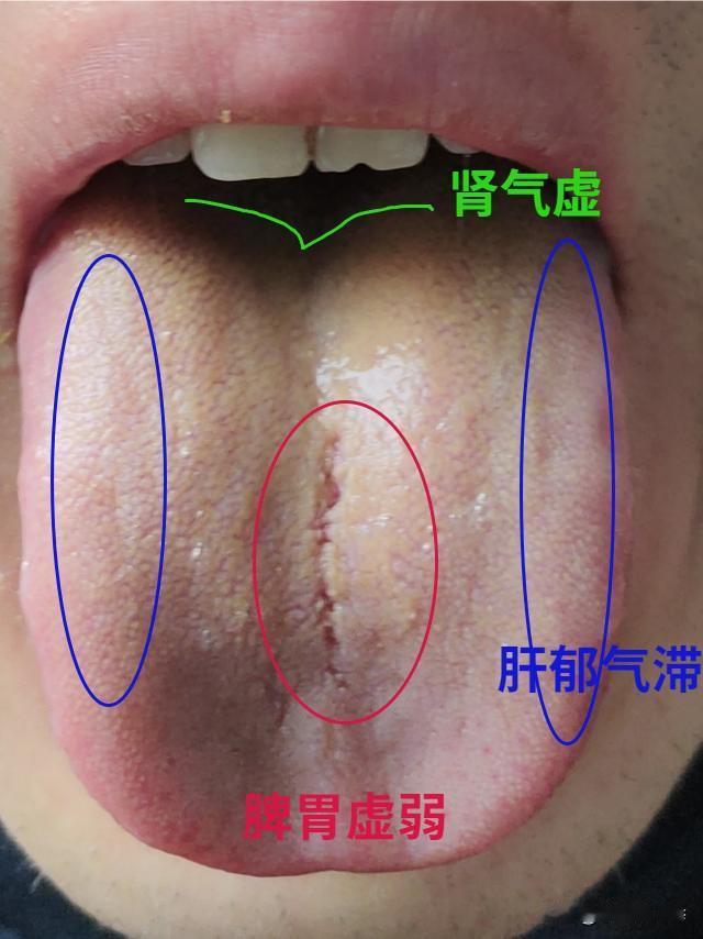 像这种舌头，舌中间裂纹又长又深，舌苔厚腻还发黄，你以为是脾胃出了问题？光补脾胃啊