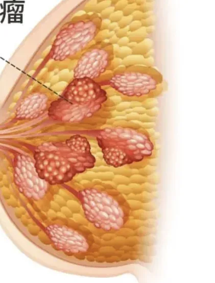 乳腺呈分叶状的病灶是不是就是分叶状肿瘤？