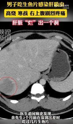 “几片鱼生，换来一张肝吸虫诊断书。”福建福州，一名男子突然高烧不退，右上腹疼得厉