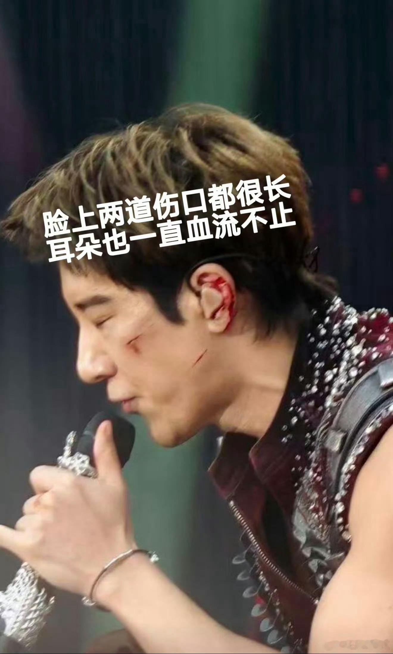 王力宏缝了39针触目惊心啊，但也是真敬业，还是坚持将演出结束，最后缝了39针 