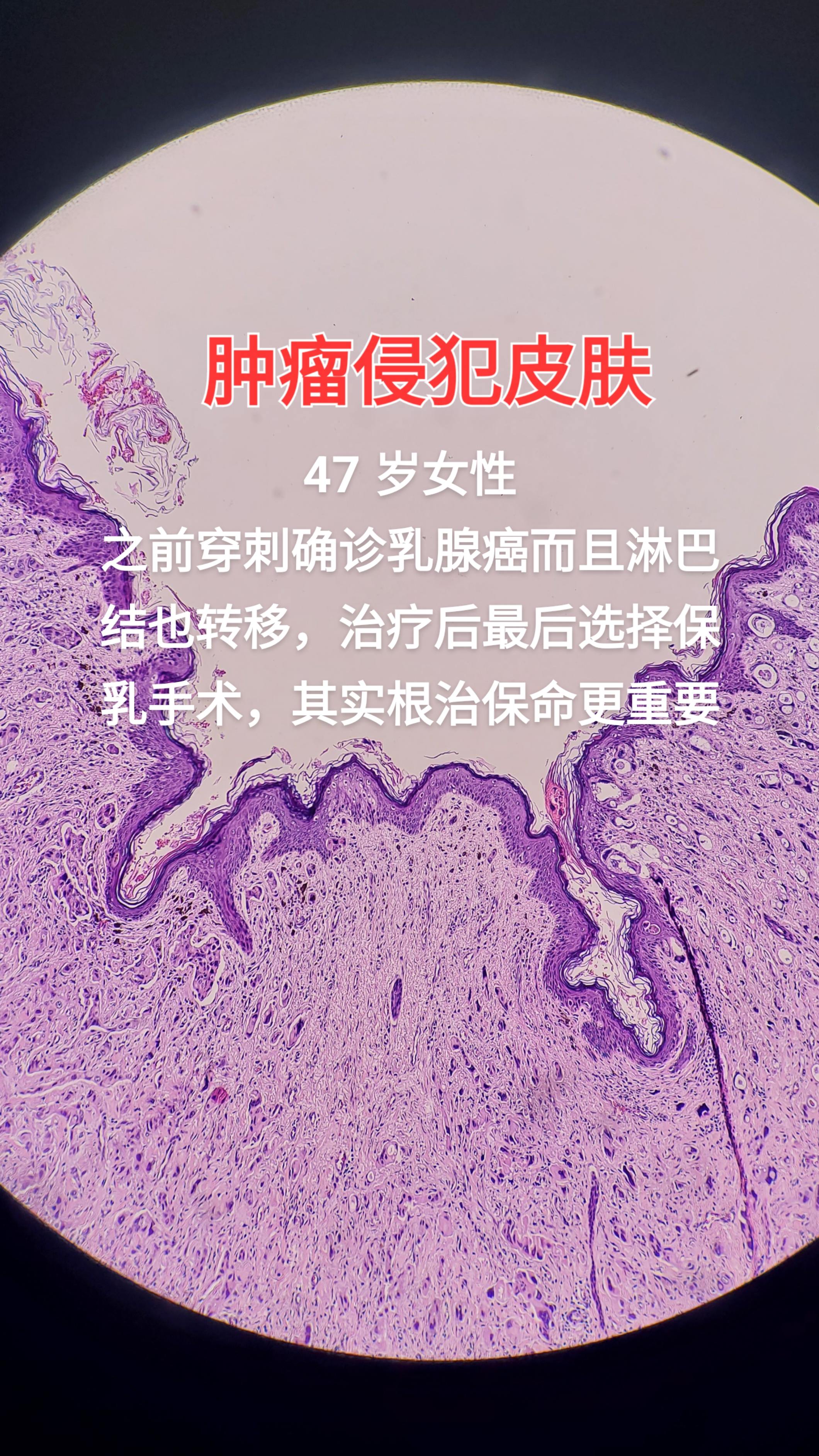 淋巴结转移