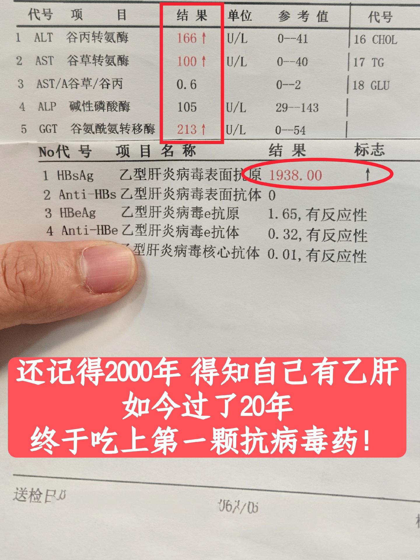 这位患者是山东临沂人，今年50岁。2000年就知道自己有乙肝，这些年每...