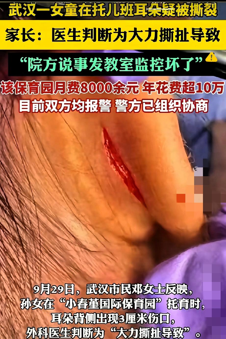 8000块一个月的高端托儿班，把孩子耳朵弄出3厘米伤口，还想蒙混过关？
 

医