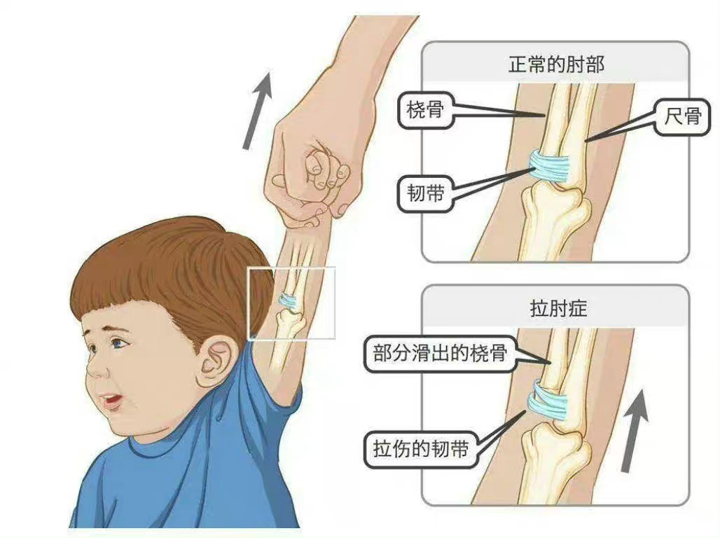 #这就是中医的神奇之处#实际上翻开 西方医疗史，桡骨小头半脱位在17世纪被传统西