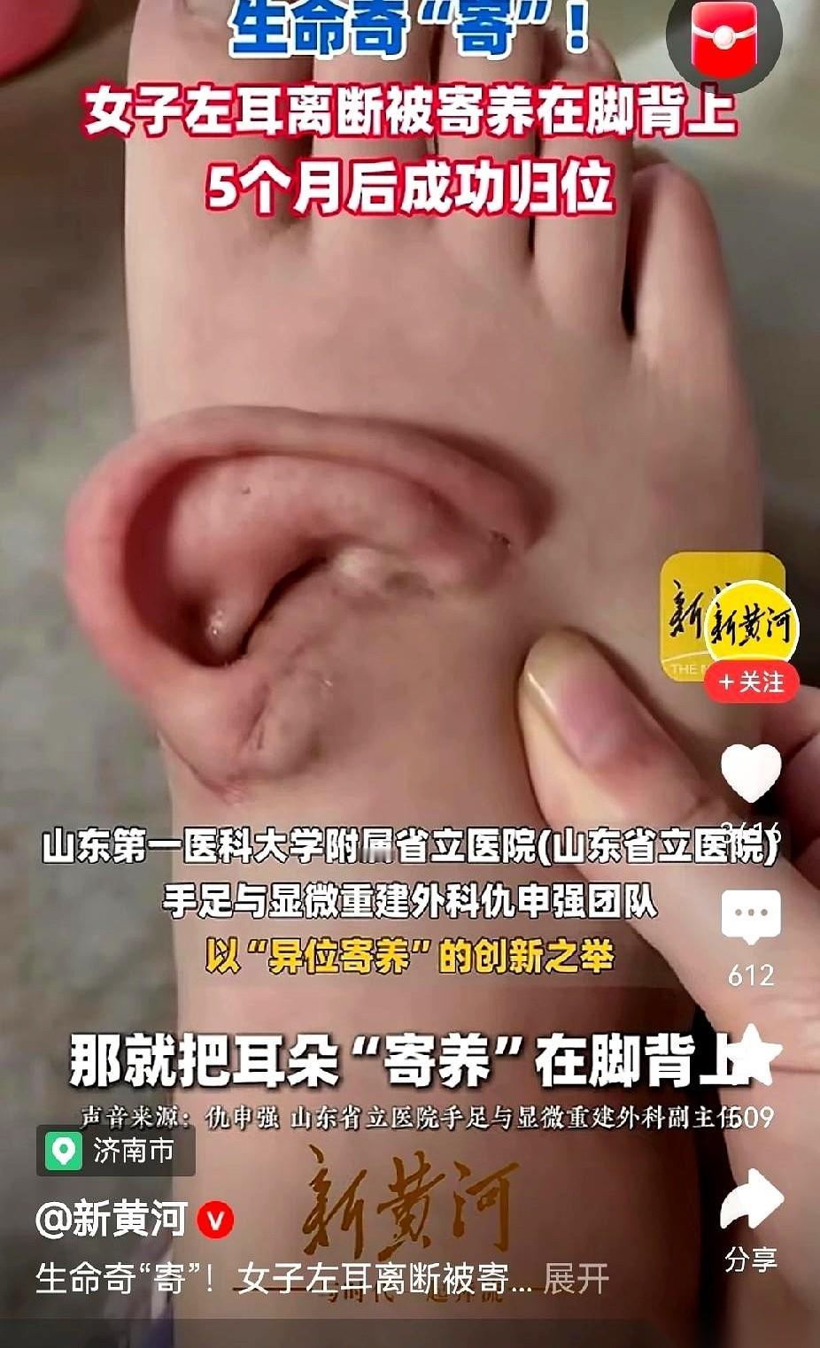 我的天，刚刷到一个新闻，差点把手机给我吓飞了。
一个耳朵，活生生地长在脚脖子上。