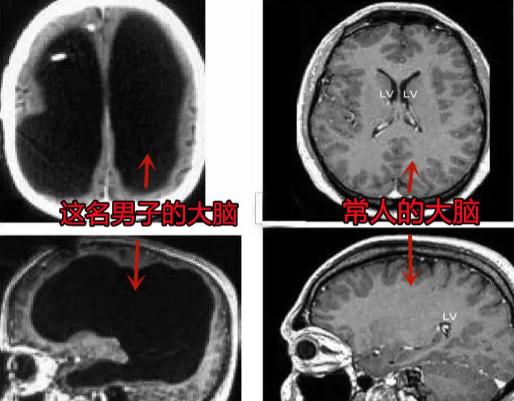 2007年，法国惊现一个“无脑”奇人！一名男子在进行脑部检查时，发现其颅内空空如