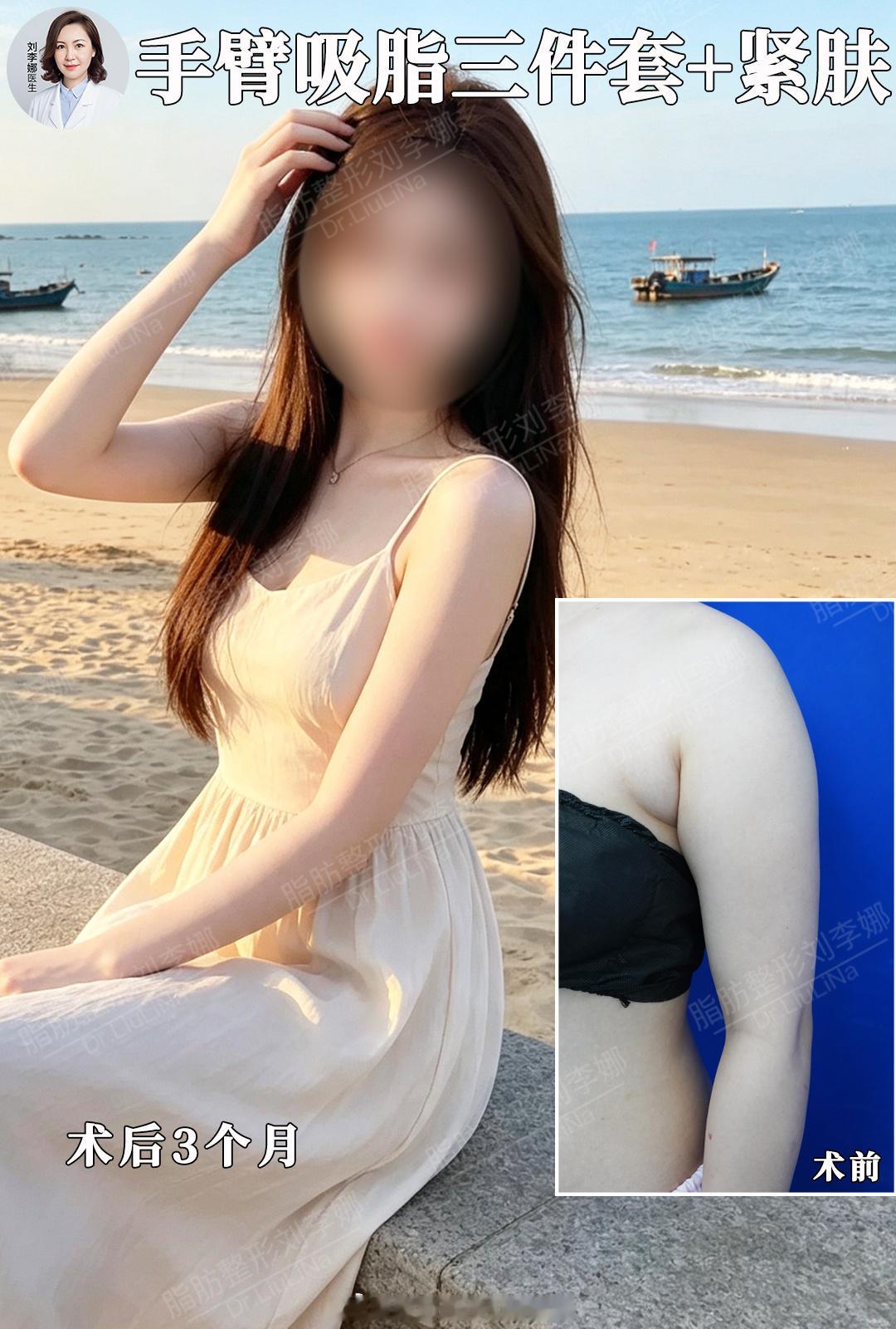 手臂吸脂吊带三件套3个月分享小姐姐被拜拜肉、副乳、肩胛厚困扰很久，做完手臂吸脂三