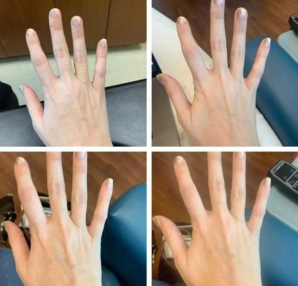 贫血患者在输铁前后的对比图，第一张和最后一张照片相距约 6 小时...