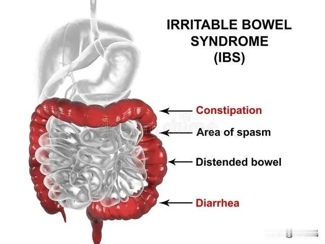 判断是否为肠易激综合征（IBS），主要从以下几个方面着手：
一、典型症状：
  