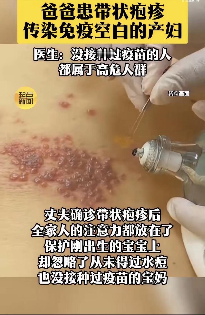 糊涂啊!宝爸得带状疱疹，全家只顾护娃，忘了23天的宝妈没抗体
深圳一位刚生娃23