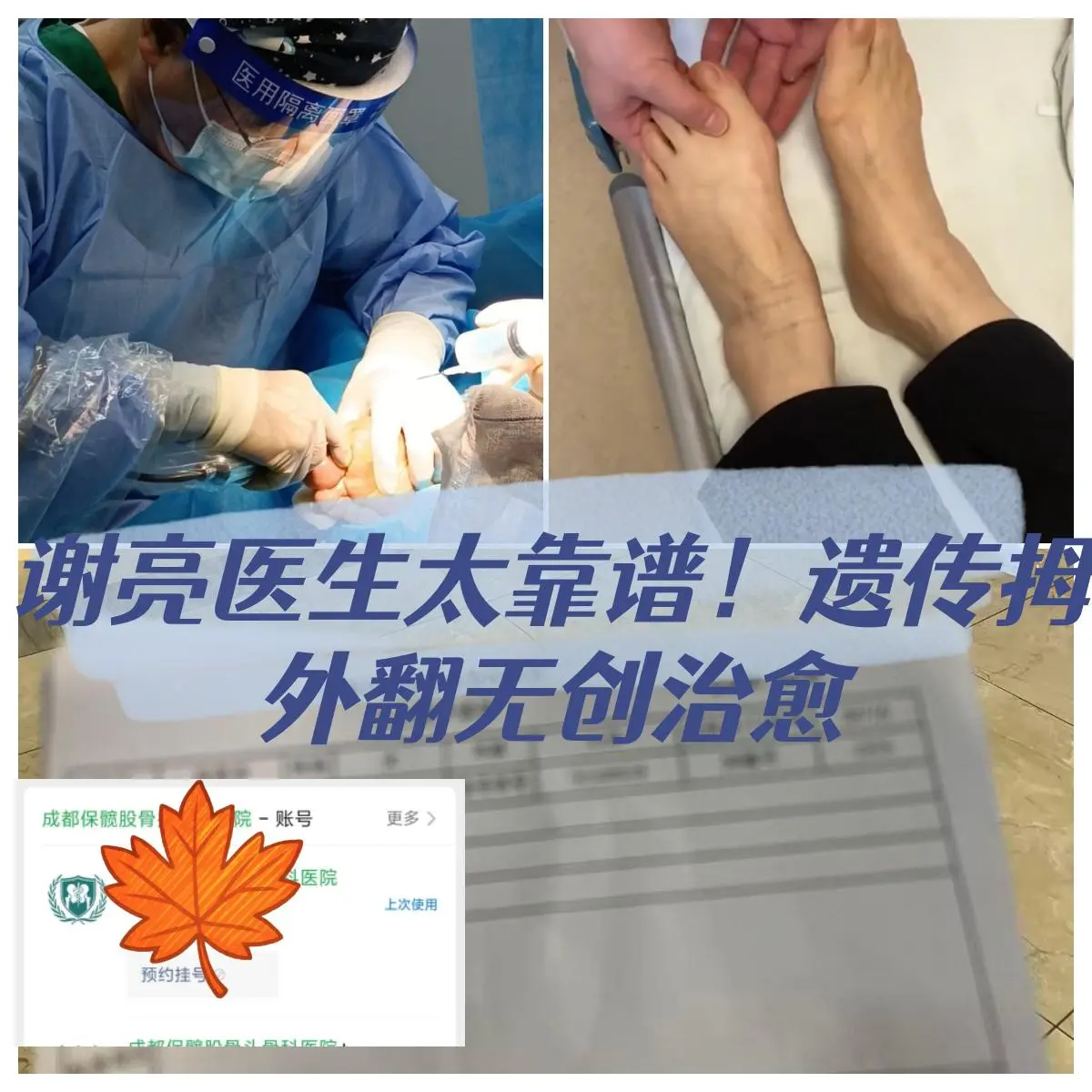 谢亮医生太靠谱！遗传拇外翻无创治愈 我的拇外翻是遗传的，双脚骨头突出很...