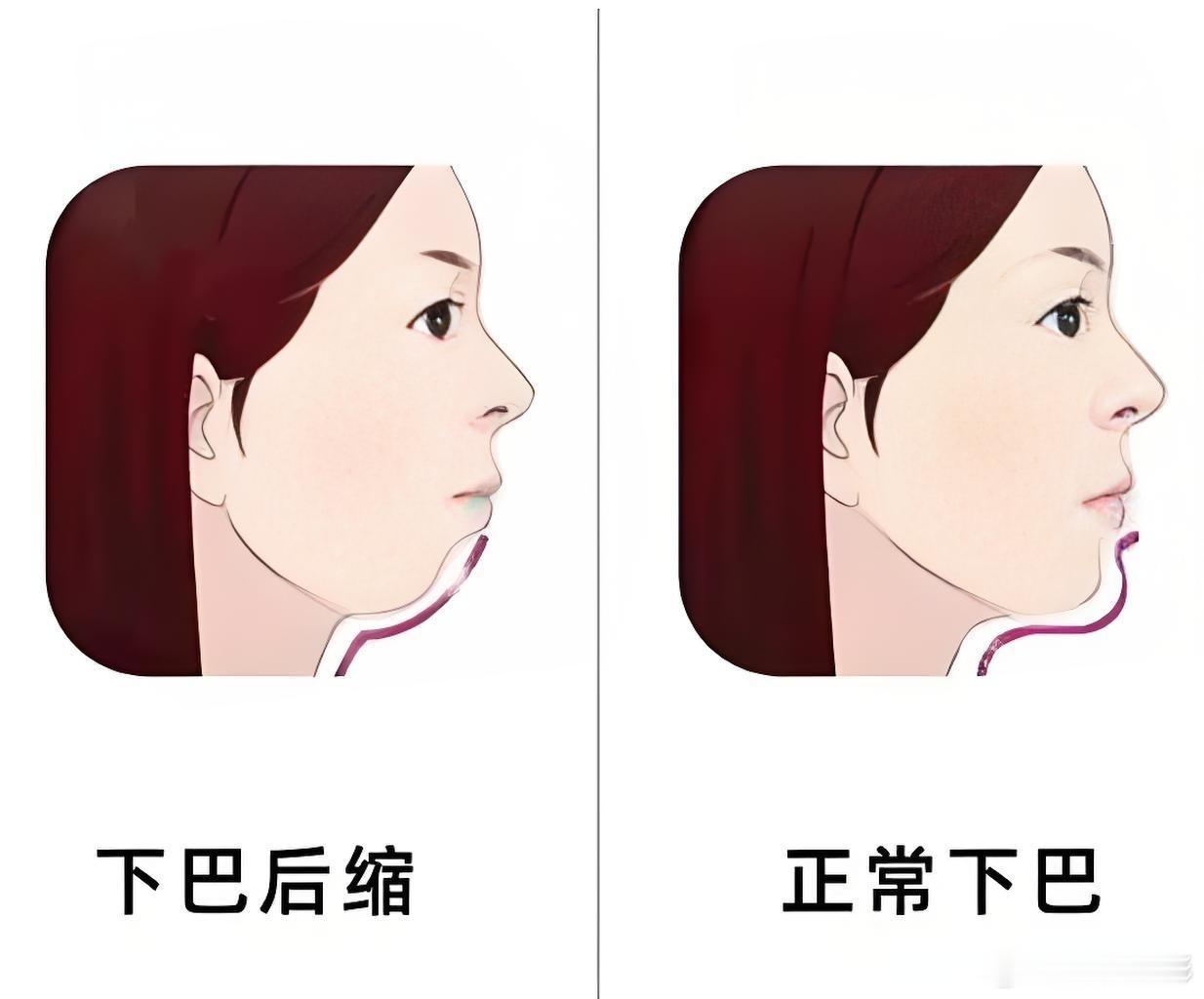 田亮女儿进行下巴后缩矫正 下巴后缩的最佳矫正年龄通常取决于个体的具体情况，但一般
