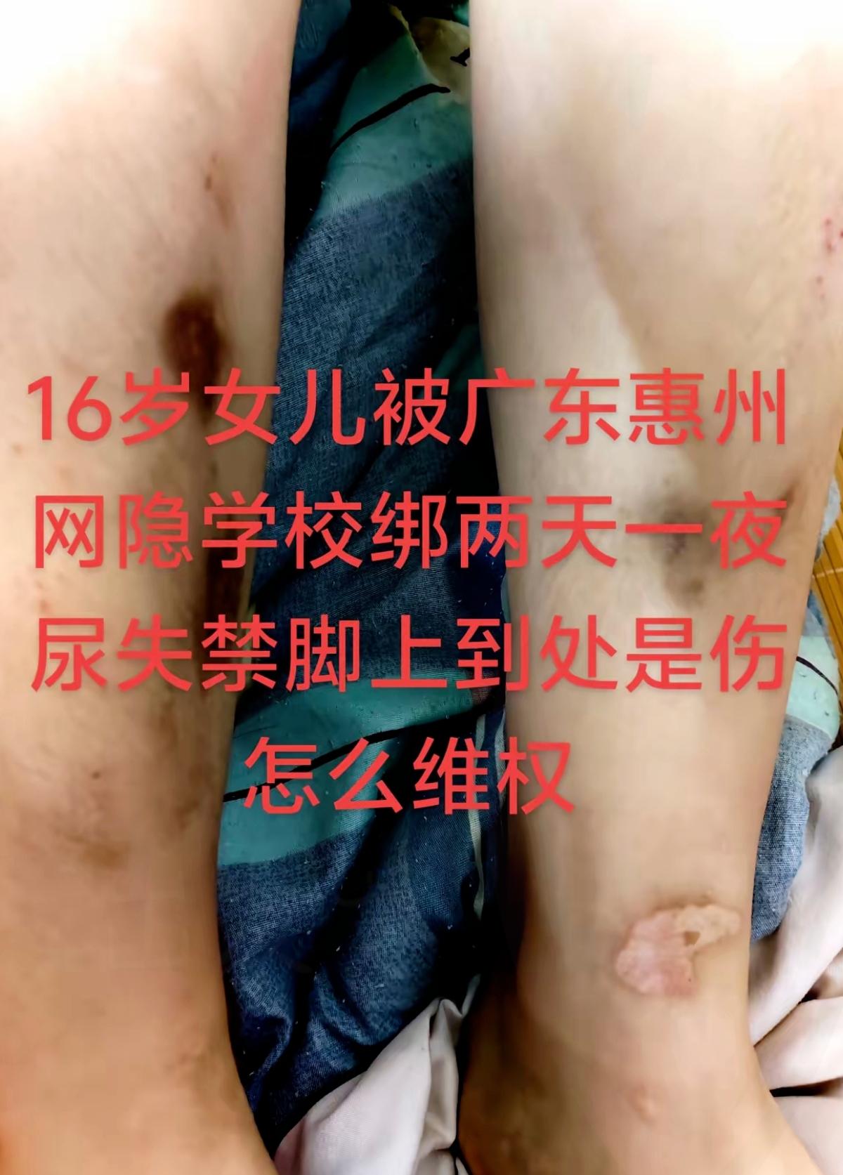 16岁女儿在惠州封闭式学校遭教官欺凌绑架，被折磨到尿失禁、满脚是伤，还落下精神异