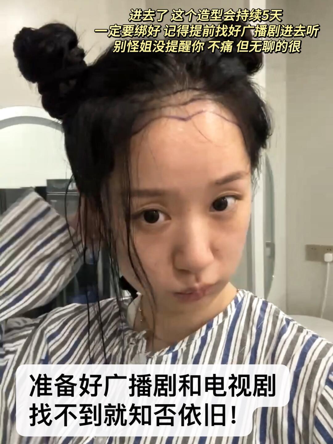 考虑了五年要不要做发际线，终于这一天！