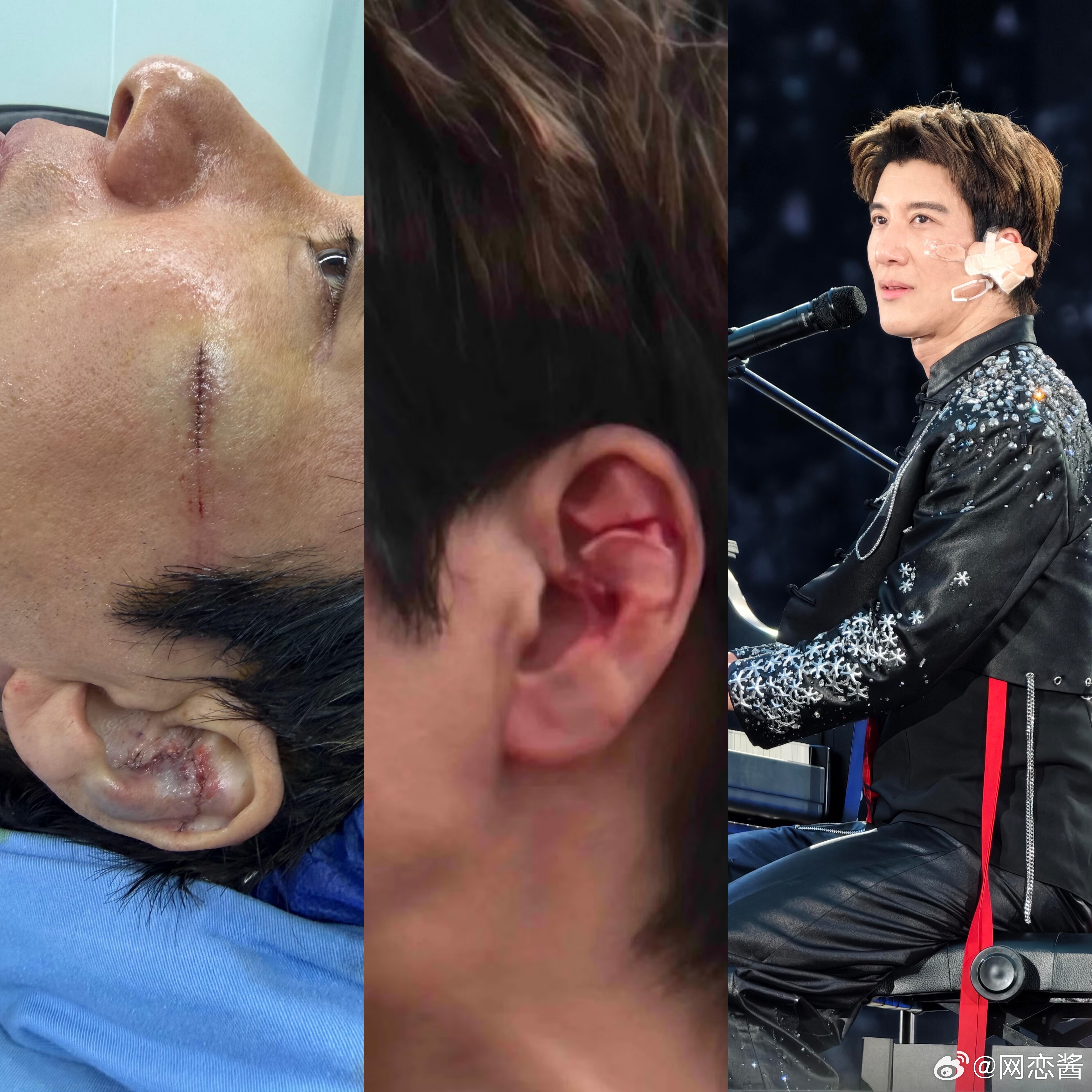 我问我学医的朋友， 王力宏缝39针脸以后会受影响吗。 我朋友叹了口气说，这事儿还