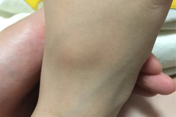小孩脚背骨头凸起图片