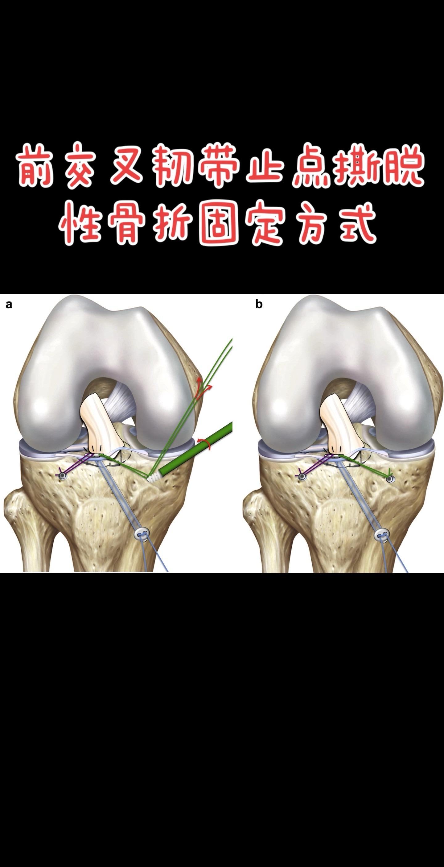 前交叉韧带止点撕脱性骨折。固定方式
