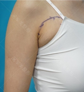 有副乳怎么办？ 副乳 副乳吸脂 吸脂 大多数副乳对健康无害，主要影响美观。但真性