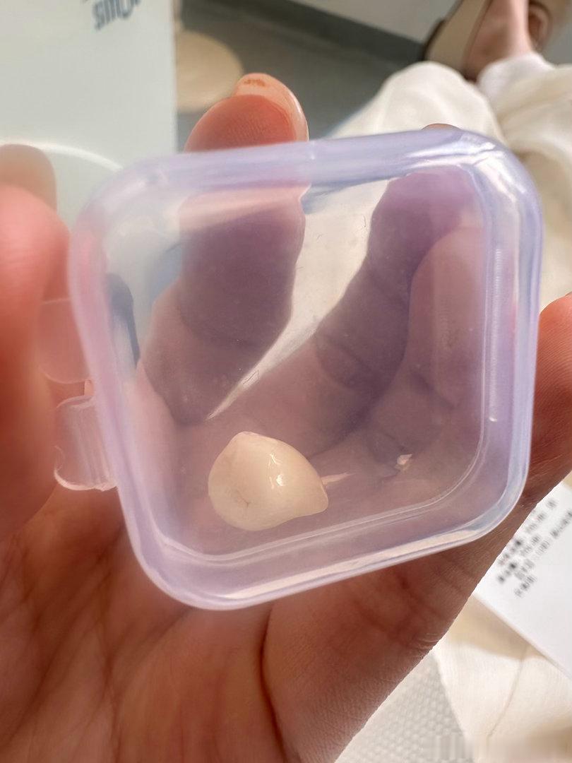 价值4980的牙冠保护好牙吧 