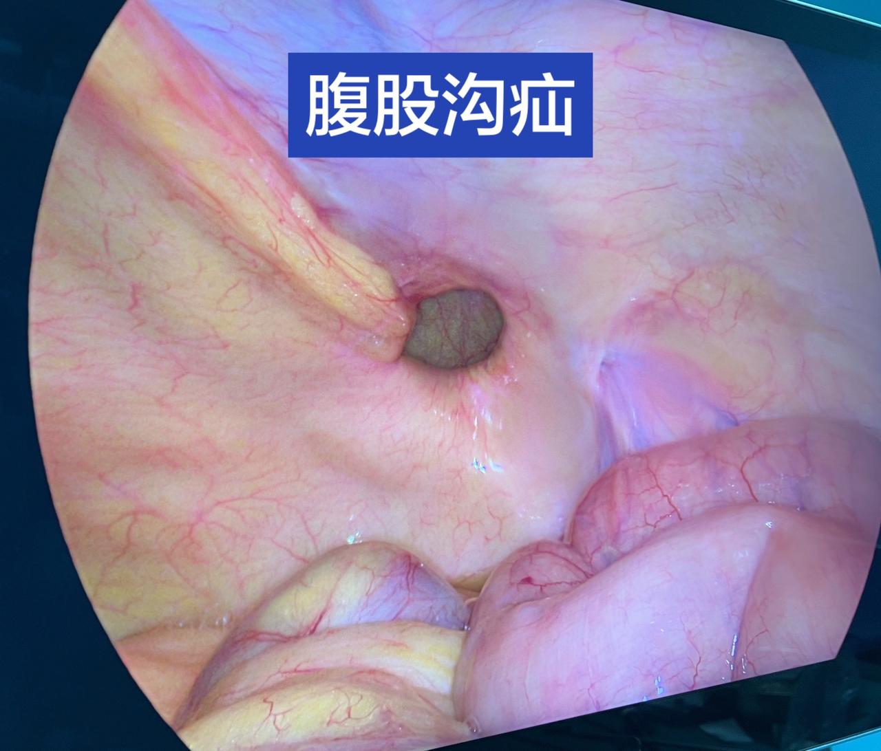 这就是腹股沟疝！从肚子里面看，腹壁上有个洞，肠管会掉到洞里去，从外面看，就是大腿