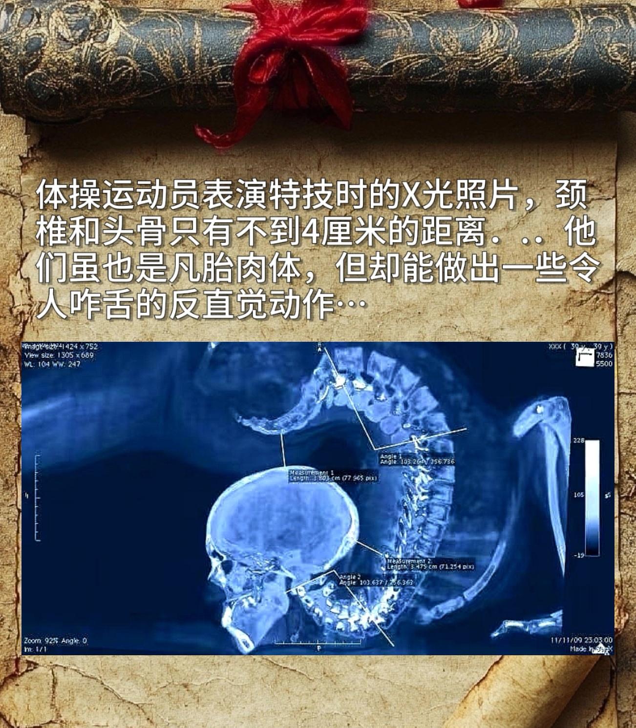 体操运动员表演特技时的X光照片，颈椎和头骨只有不到4厘米的距离，他们虽...