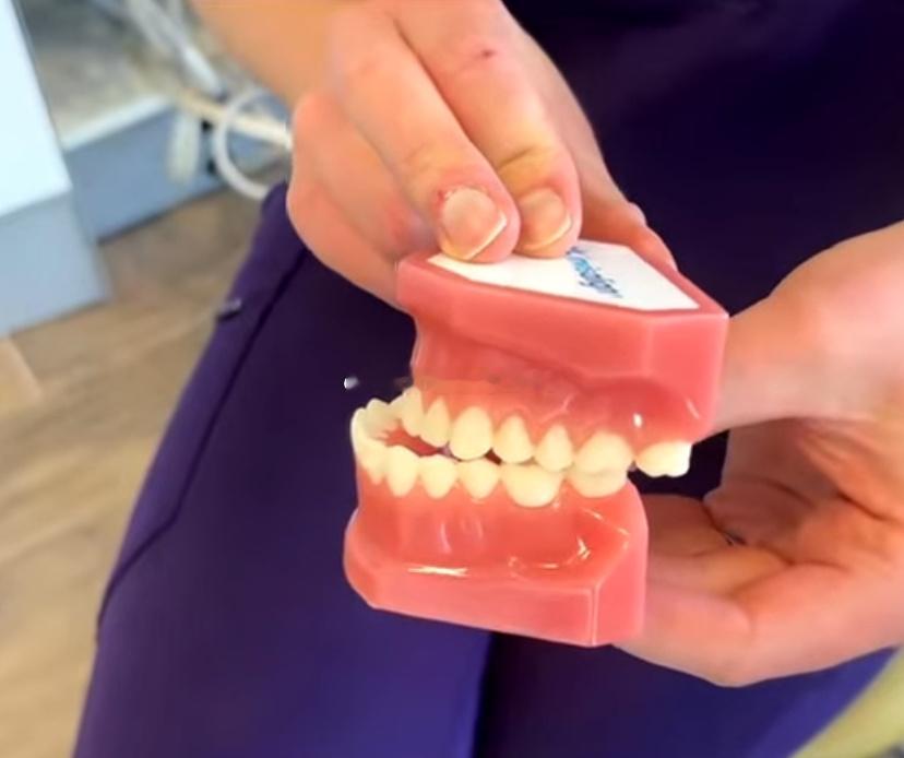 反颌：“地包天”不只是影响美观反颌，在日常生活中有一个更通俗的说法叫“地包天”。