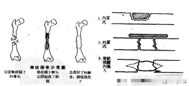 太神奇了！一根柳条就可以接上断骨，听上去就非常不可思议，但这却是中医里真实存在的