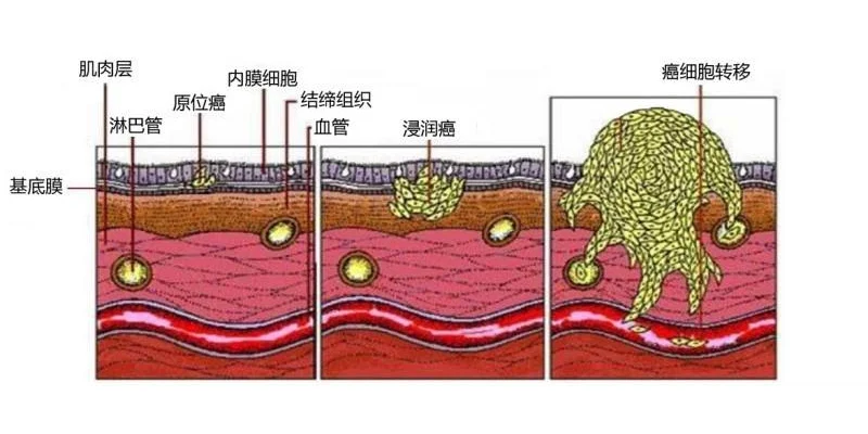 原位癌和浸润癌主要区别是癌细胞是否已经浸润周围包膜。 原位癌的癌细胞尚...