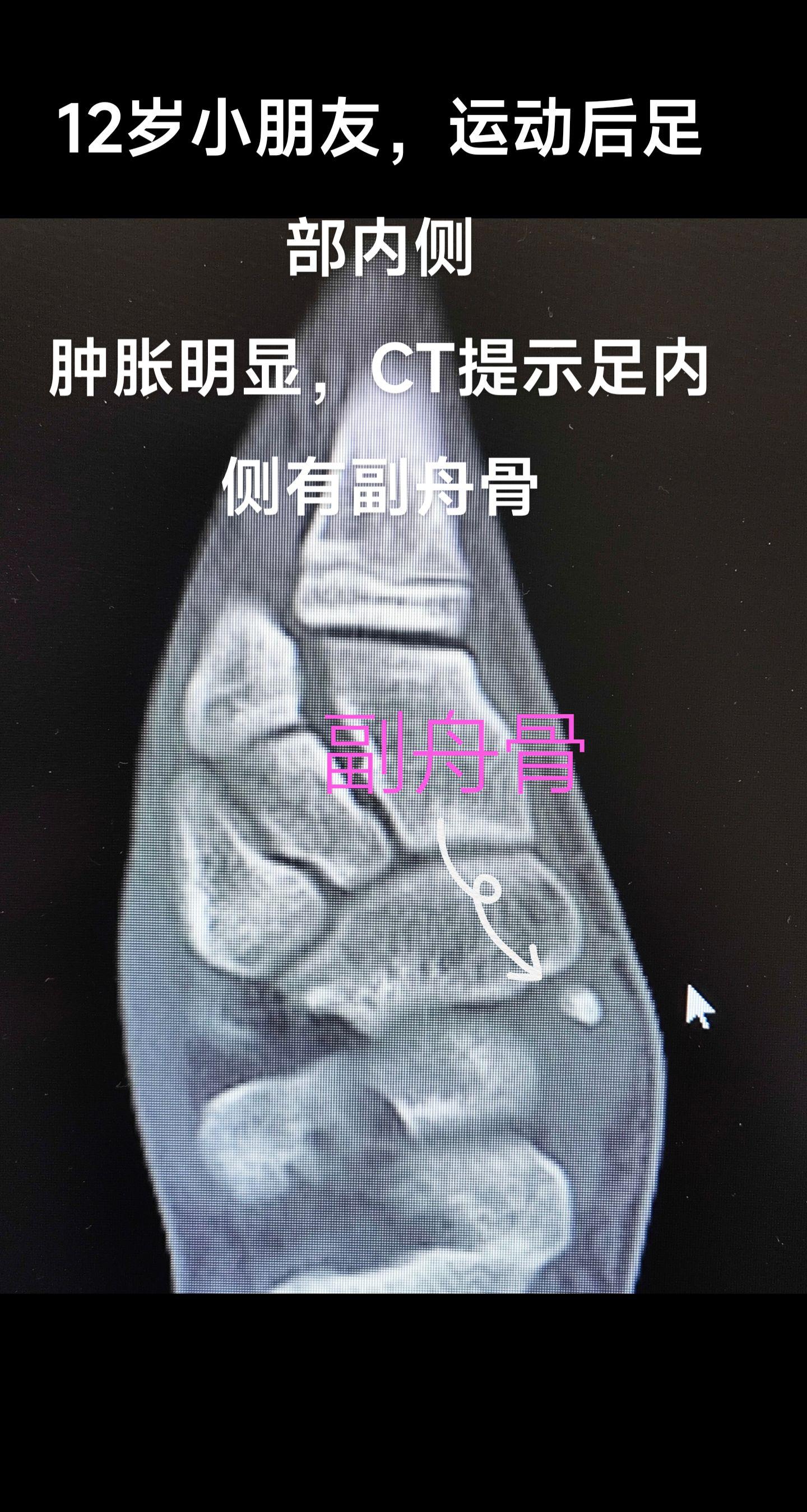 足副舟骨疼痛。