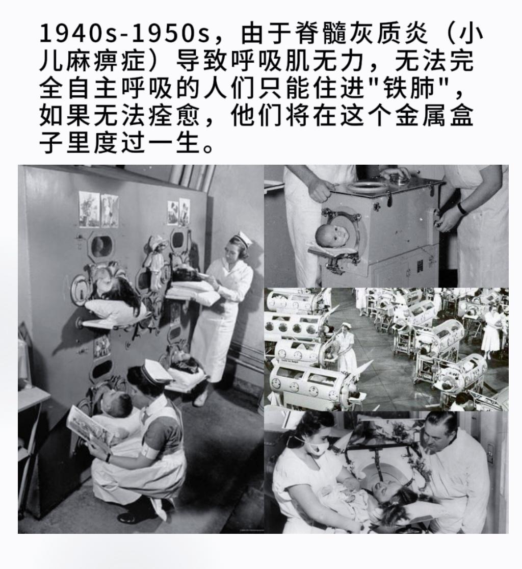 1940s-1950s，由于脊髓灰质炎（小儿麻痹症）导致呼吸肌无力，无...