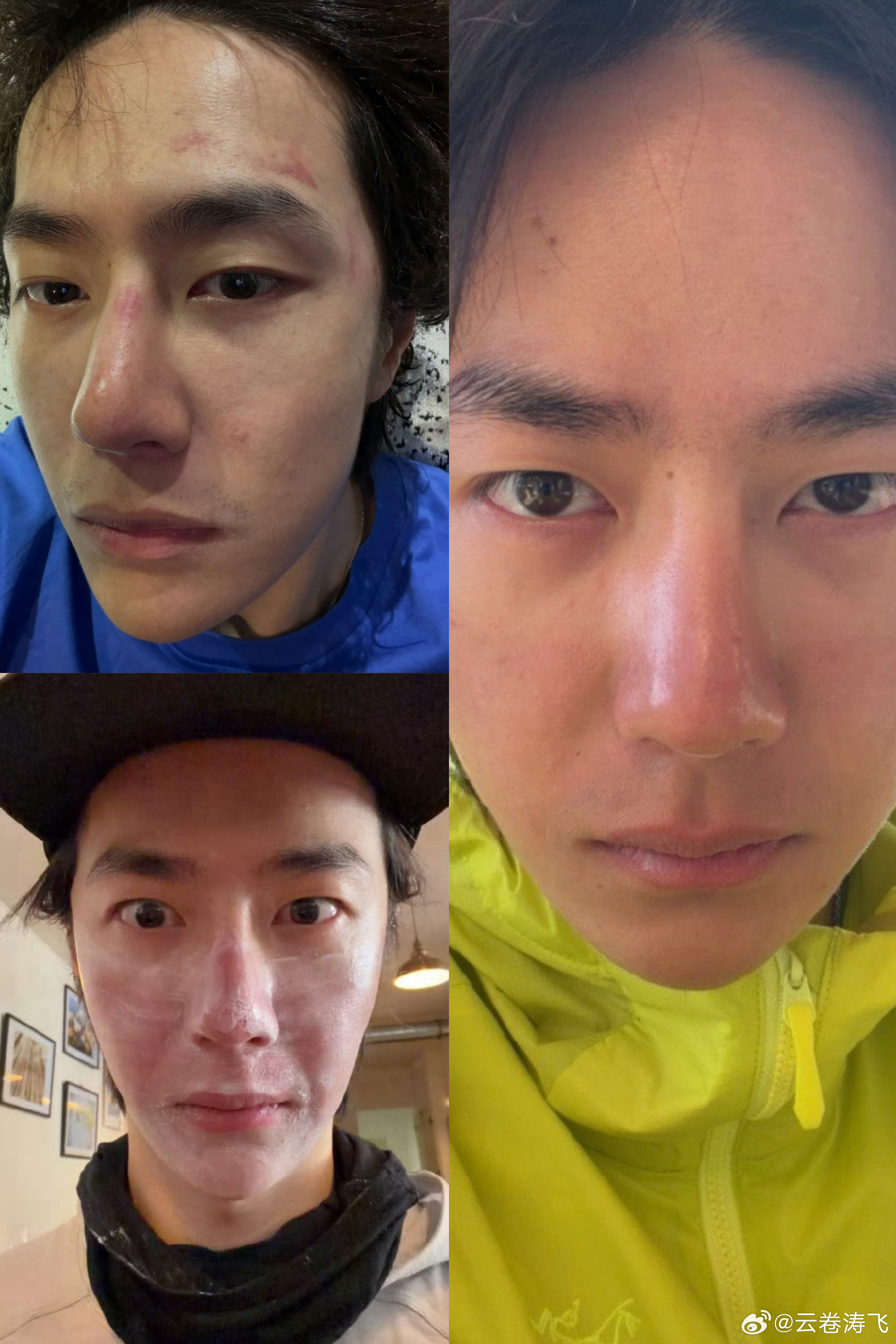 之前只是胳膊晒分层，这下脸也晒分层了[笑cry][笑cry][笑cry]红的地方