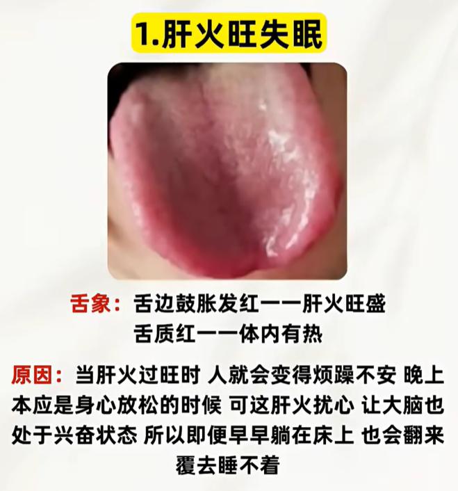 入睡难、多梦易醒，从舌象分清失眠根源在哪
