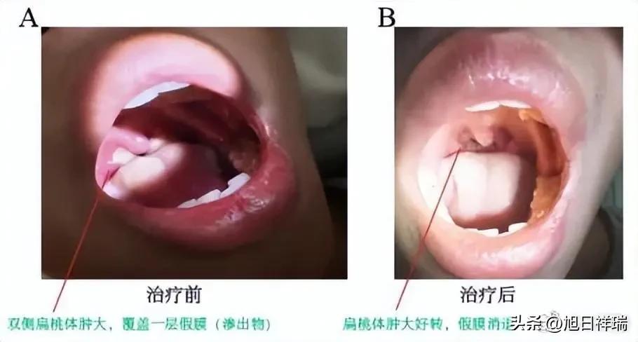 23岁男子反复高烧、喉咙痛到吞不下水，以为是重感冒，结果确诊“亲吻病”。医生：这