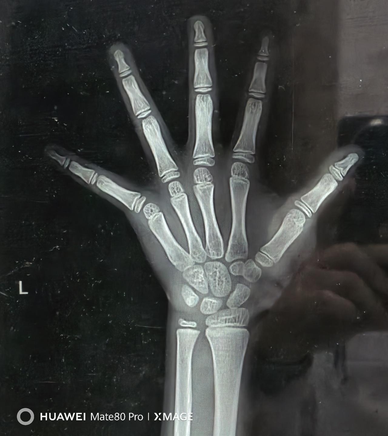 6岁女童单侧乳房肿痛半年，骨龄超前2.5岁！一针抑制，守住终身高才是关键！
今天