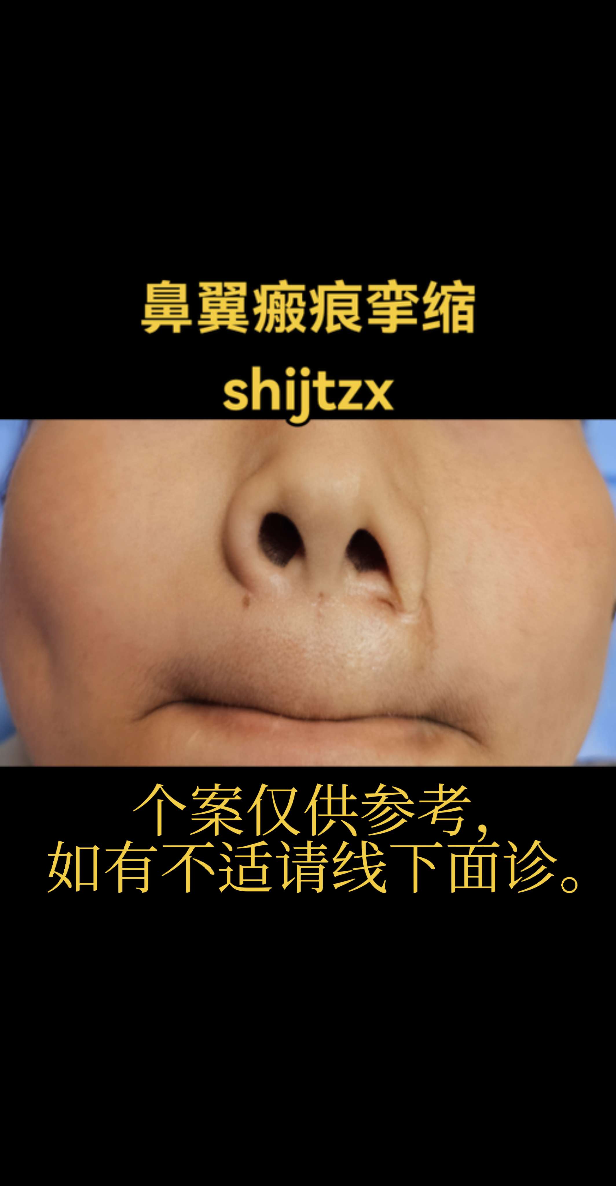 鼻翼瘢痕术前。