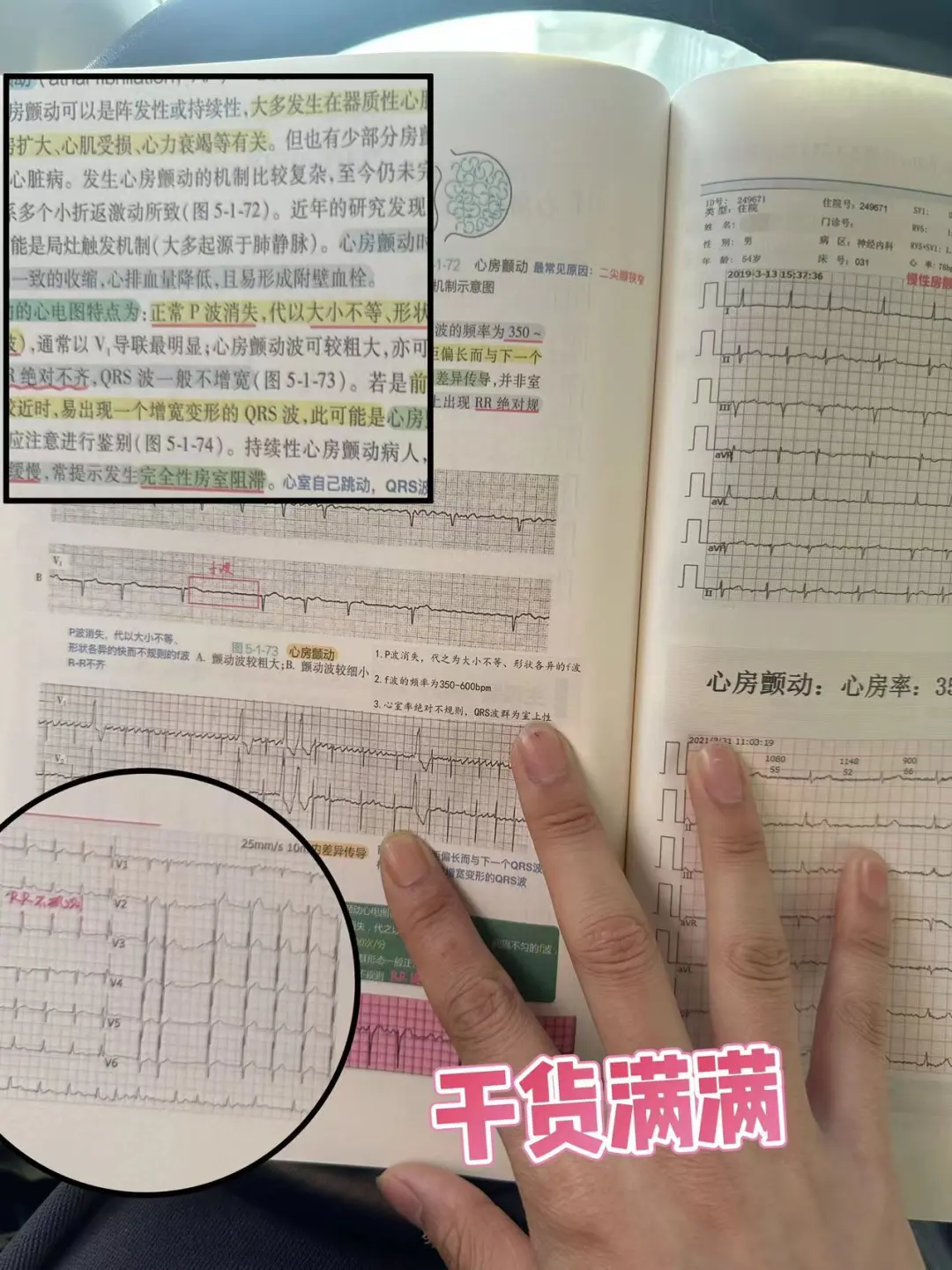 规培夜班心电图干货