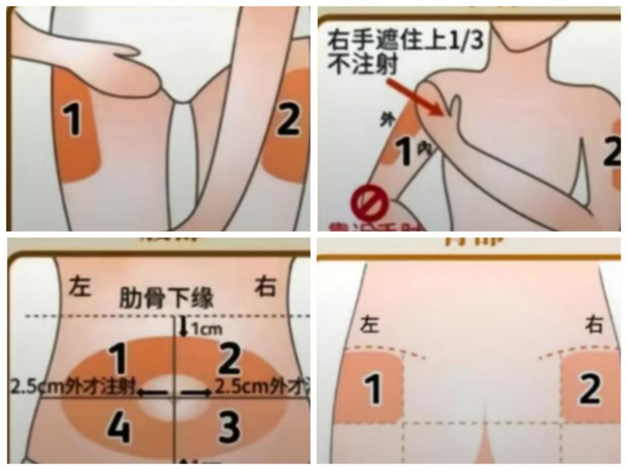 胰岛素注射部位为：大腿、上臂、臀部、腹部四部分。
        一，大腿应选择