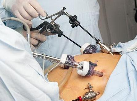 重庆，一女子在做了肾上腺良性肿瘤和胆囊切除手术20年后，意外检查出腹部遗留了一枚